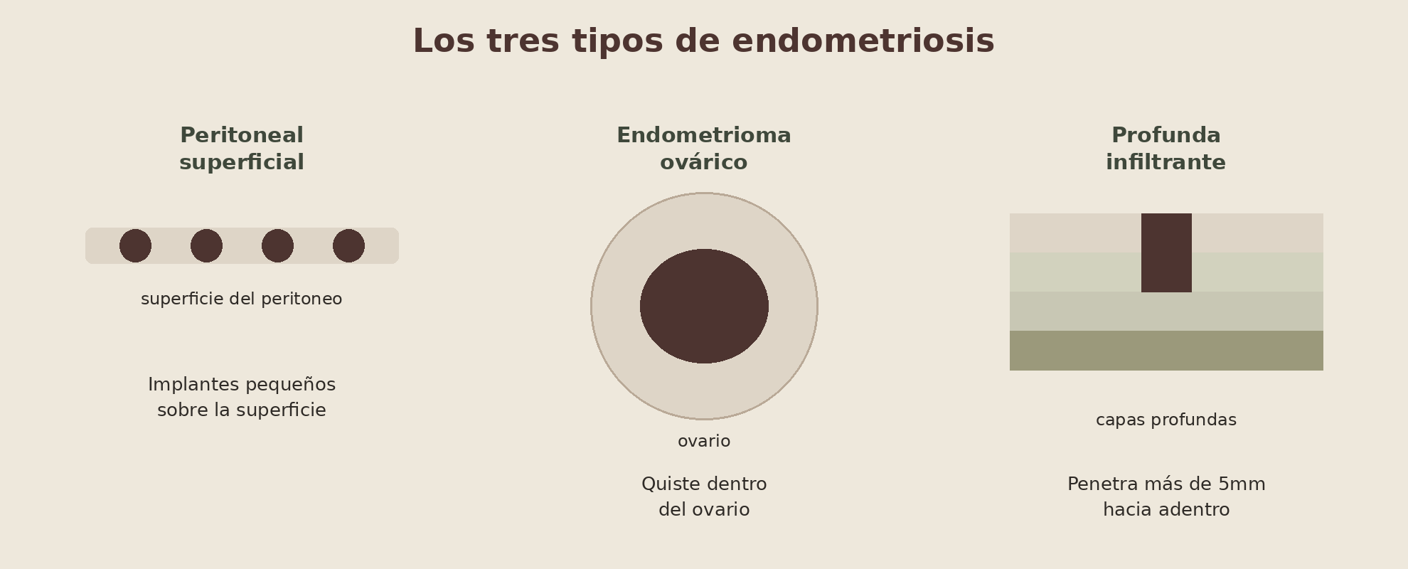 Los tres tipos de endometriosis: peritoneal superficial, endometrioma ovárico, y profunda infiltrante